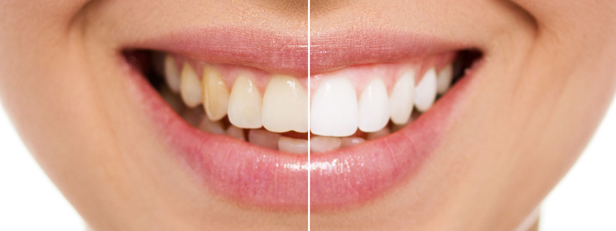 Teeth Whitening before and after treatment