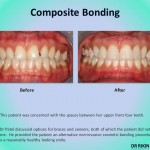 Composite Bonding