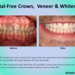 Metal Crown Veneers and Whitening