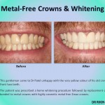 Metal Crown Veneers and Whitening 2