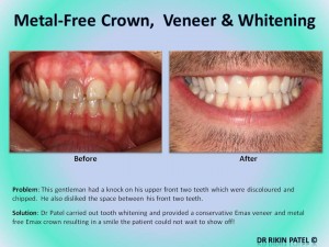 Metal Crown Veneers and Whitening