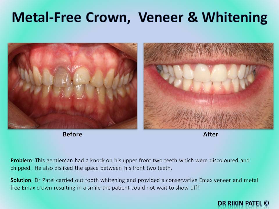 teeth whitening for crowned teeth