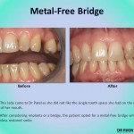 Metal Free Bridge