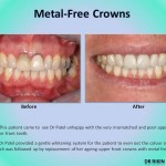 Metal Free Crowns