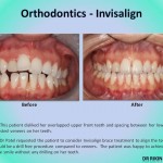 Orthodontics Invisalign