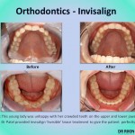 Orthodontics Invisalign 2