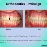 Orthodontics Invisalign 3