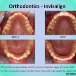 Orthodontics Invisalign 6