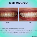 Tooth Whitening