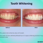 Tooth Whitening 2