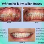 Whitening and Invisalign