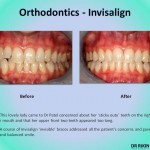 Orthodontics Invisalign 4