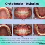 Orthodontics Invisalign 5