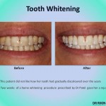 Tooth Whitening 3