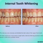 Tooth Whitening 4